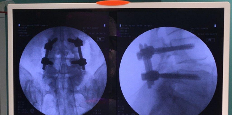 Operacja stenozy kręgosłupa lędźwiowego nowoczesną metodą w Szpitalu Specjalistycz